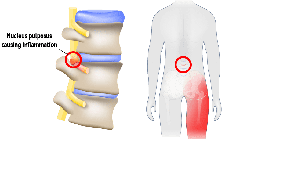 Disc Herniation Or Rupture Disc Causes Hip Pain - Dr. Kevin Pauza