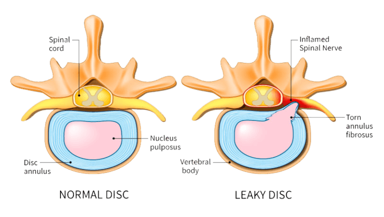 Herniated disc meaning