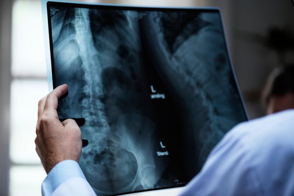 problems with spine implants