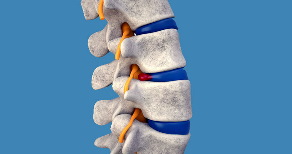Quickly Heal Herniated Spine