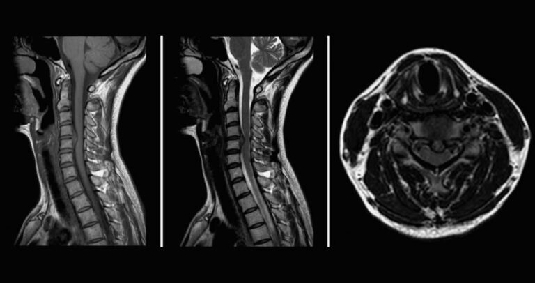 Herniated Cervical Disc Mri Discseel