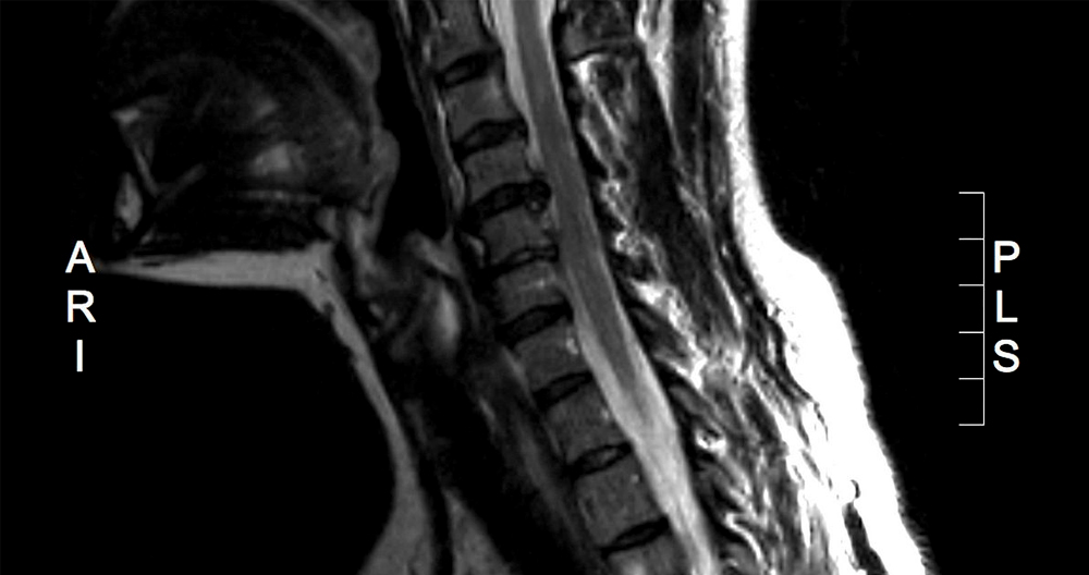MRI to Diagnose a Herniated Disc