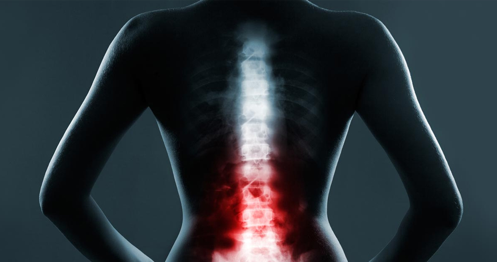 Three Types of Herniated Discs
