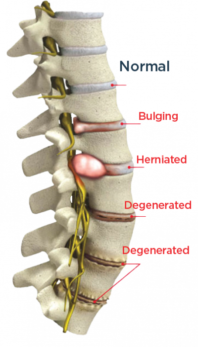 spine_conditions_3